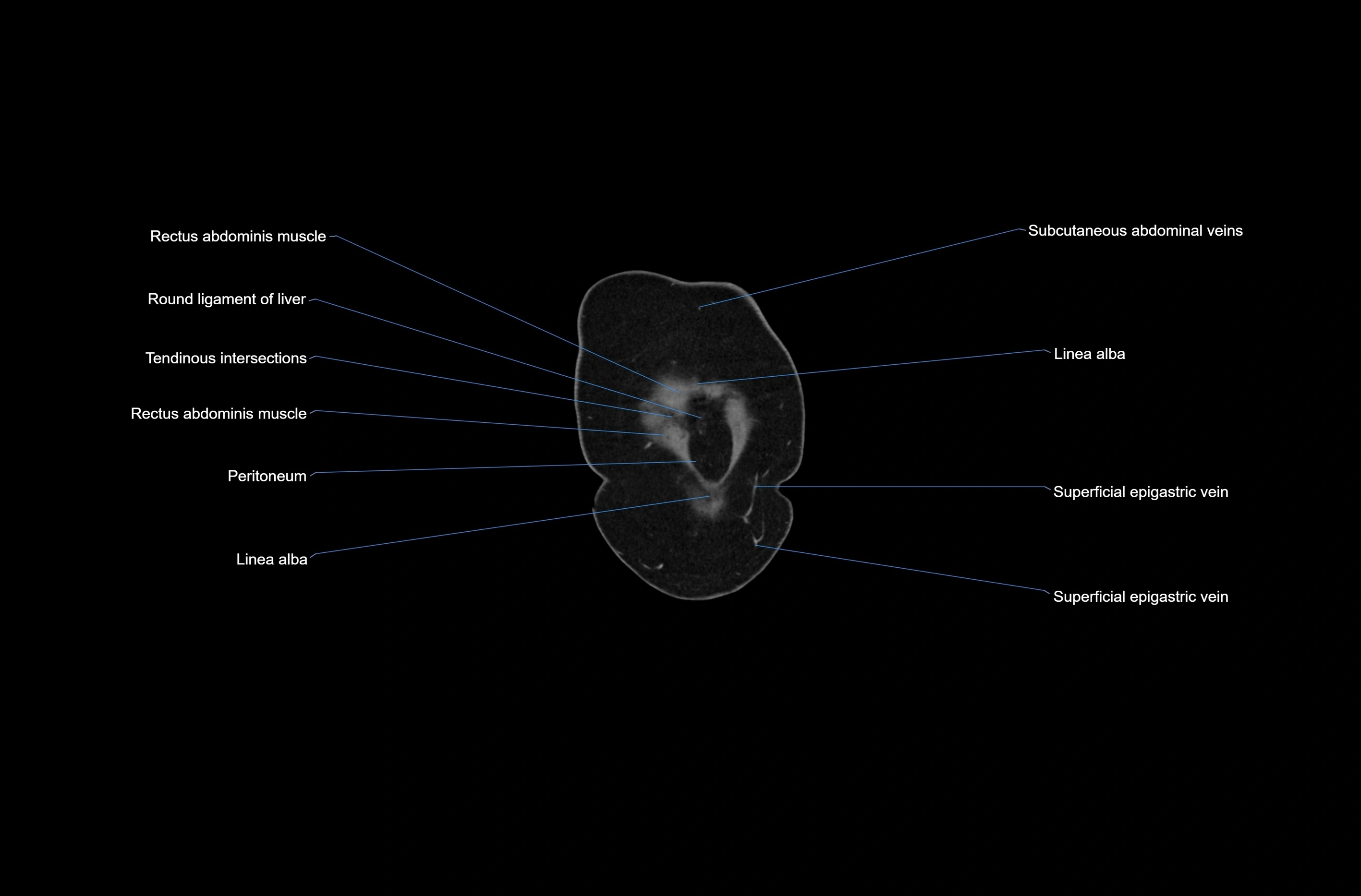 CT abdomen coronal cross sectional anatomy labelled radiology image-00004.webp